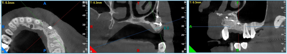 GBR dental tenting screws for bone grafting in anterior esthetic areas. - 13