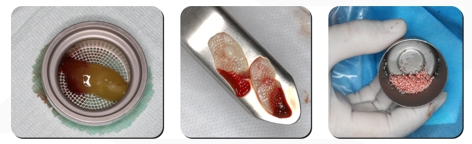 Immediate Implantation and GBR Techniques for Maxillary Anterior Teeth - 14 1