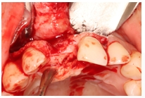 GBR Surgery in Maxillary Anterior Area - 14