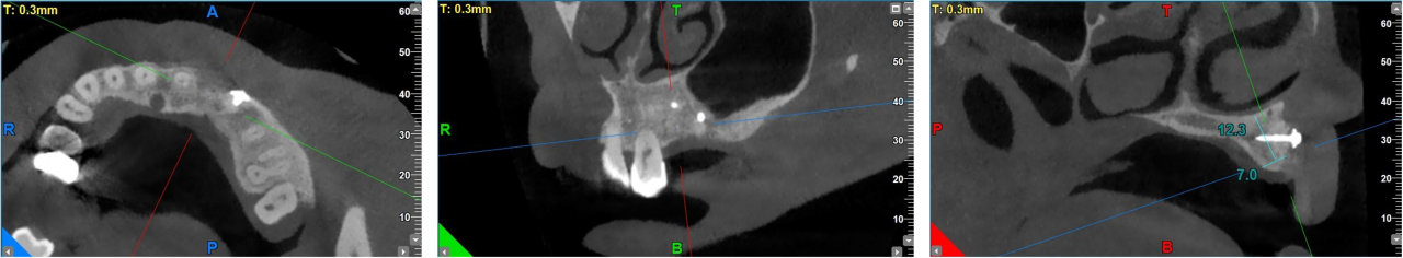 GBR dental tenting screws for bone grafting in anterior esthetic areas. - 14