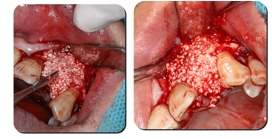 Immediate Implantation and GBR Techniques for Maxillary Anterior Teeth - 15 1