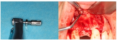 GBR Surgery in Maxillary Anterior Area - 15