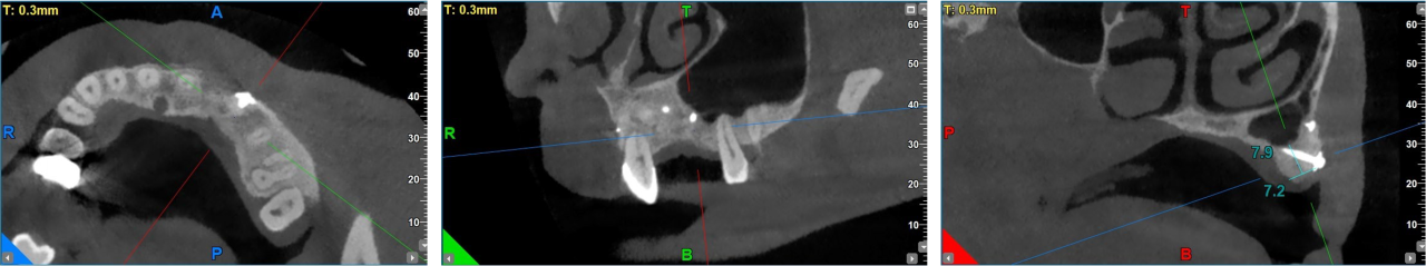 GBR dental tenting screws for bone grafting in anterior esthetic areas. - 15