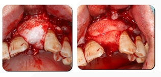 Immediate Implantation and GBR Techniques for Maxillary Anterior Teeth - 16 1