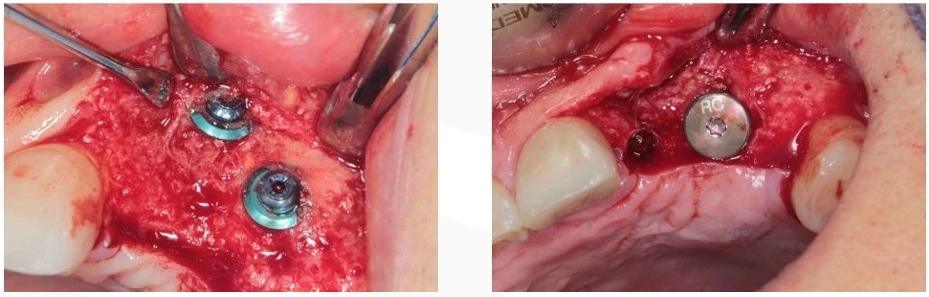 GBR dental tenting screws for bone grafting in anterior esthetic areas. - 16 3