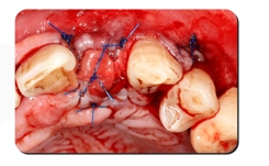 Immediate Implantation and GBR Techniques for Maxillary Anterior Teeth - 17 2