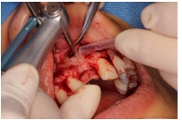 GBR Surgery in Maxillary Anterior Area - 17