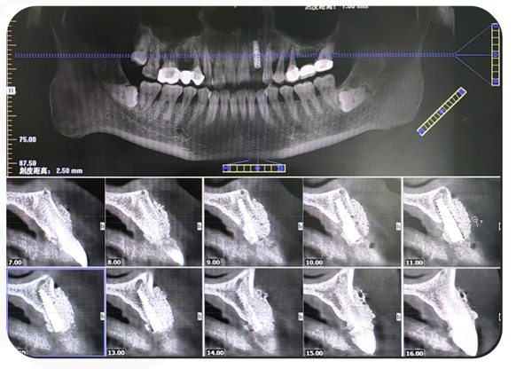 Immediate Implantation and GBR Techniques for Maxillary Anterior Teeth - 18 2