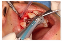 GBR Surgery in Maxillary Anterior Area -11