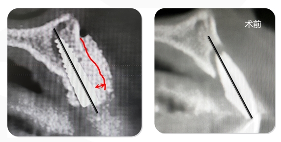 Immediate Implantation and GBR Techniques for Maxillary Anterior Teeth - 19 1