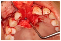 GBR Surgery in Maxillary Anterior Area - 19