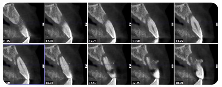 Immediate Implantation and GBR Techniques for Maxillary Anterior Teeth - 2 1