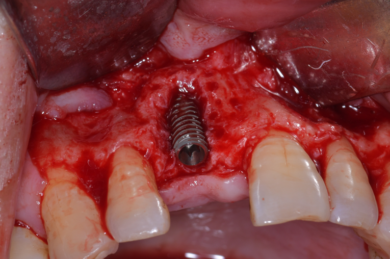 Titanium Mesh GBR Surgery in Maxillary Anterior Area - 2