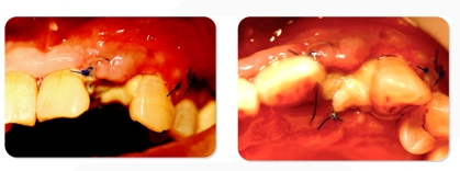 Immediate Implantation and GBR Techniques for Maxillary Anterior Teeth - 20 1