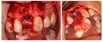 GBR Surgery in Maxillary Anterior Area - 20