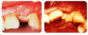 Immediate Implantation and GBR Techniques for Maxillary Anterior Teeth - 21 1