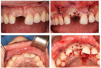 GBR Surgery in Maxillary Anterior Area - 21