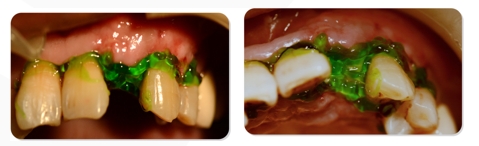 Immediate Implantation and GBR Techniques for Maxillary Anterior Teeth - 22 1