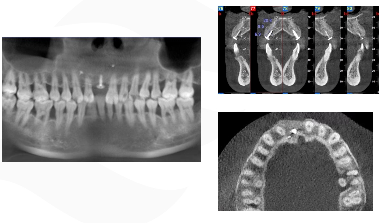 GBR Surgery in Maxillary Anterior Area - 22