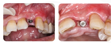 Immediate Implantation and GBR Techniques for Maxillary Anterior Teeth - 23 1