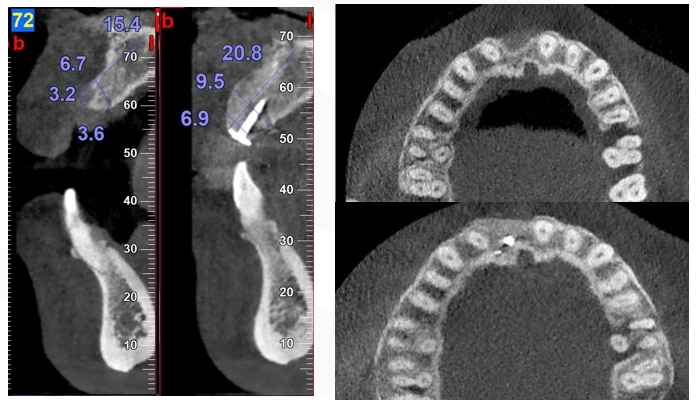 GBR Surgery in Maxillary Anterior Area - 23