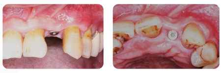 Immediate Implantation and GBR Techniques for Maxillary Anterior Teeth - 24