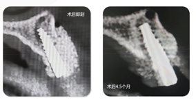 Immediate Implantation and GBR Techniques for Maxillary Anterior Teeth - 26