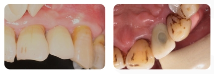 Immediate Implantation and GBR Techniques for Maxillary Anterior Teeth - 27