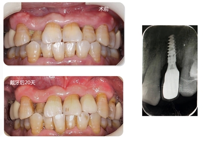 Immediate Implantation and GBR Techniques for Maxillary Anterior Teeth - 28