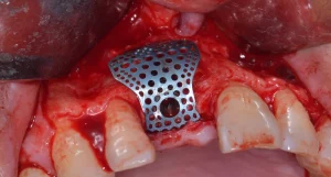 Titanium Mesh Dental Bone Graft