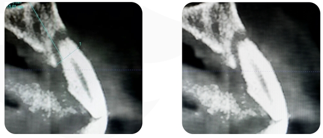 Immediate Implantation and GBR Techniques for Maxillary Anterior Teeth - 3