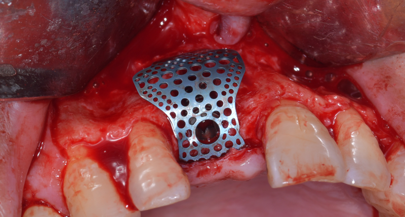 Titanium Mesh GBR Surgery in Maxillary Anterior Area - 3