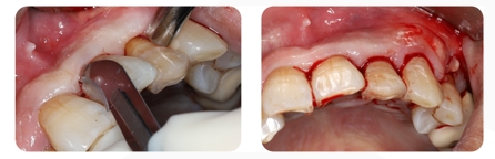 Immediate Implantation and GBR Techniques for Maxillary Anterior Teeth - 4