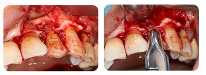 Immediate Implantation and GBR Techniques for Maxillary Anterior Teeth - 5