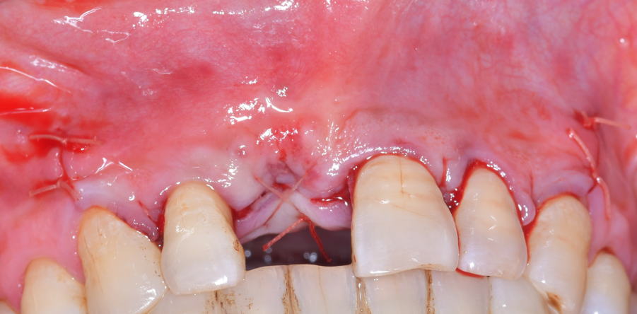 Titanium Mesh GBR Surgery in Maxillary Anterior Area - 5