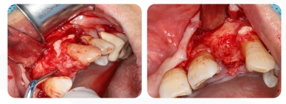 Immediate Implantation and GBR Techniques for Maxillary Anterior Teeth - 6