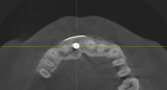 Titanium Mesh GBR Surgery in Maxillary Anterior Area - 6