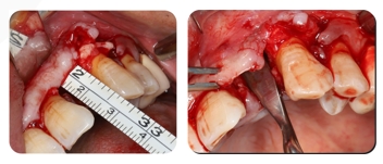 Immediate Implantation and GBR Techniques for Maxillary Anterior Teeth - 7