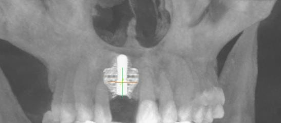 Titanium Mesh GBR Surgery in Maxillary Anterior Area - 7