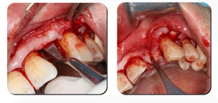 Immediate Implantation and GBR Techniques for Maxillary Anterior Teeth - 8