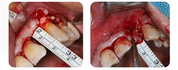 Immediate Implantation and GBR Techniques for Maxillary Anterior Teeth - 9