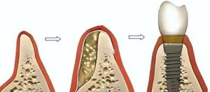 Guided Bone Regeneration