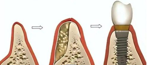 Comprehensive Guide to Guided Bone Regeneration (GBR) Procedure in Dental Implantology - GBR e1731036495216