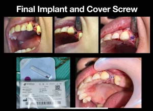 surgical process