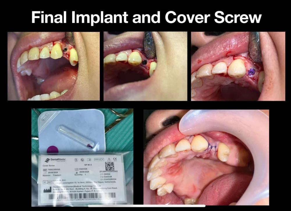 Dr. Gelo Militante Performs Implant Surgery Using DentalMaster Implants and Cover Screws - fd17322a 952d 42a5 8c9d a6a3ab3a0262