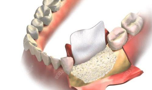 Guided Bone Regeneration (GBR)