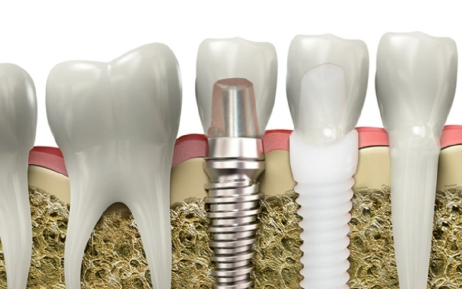 Łączniki dentystyczne: Rodzaje, procedura i poziomy bólu