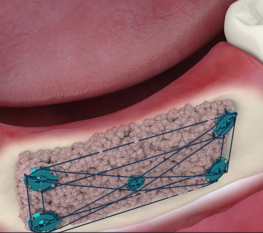 Tenting Screws and Bone Grafts