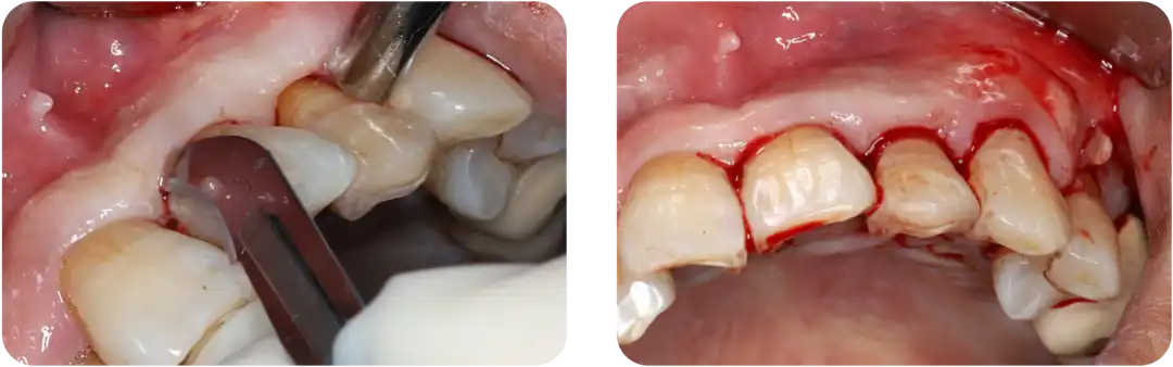 Immediate Implant Placement for Upper Anterior Teeth: DMDriving 3.5 Implants + GBR for Bone Grafting - 微信图片 20250123150604