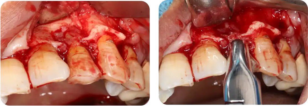 Immediate Implant Placement for Upper Anterior Teeth: DMDriving 3.5 Implants + GBR for Bone Grafting - 微信图片 20250123150702